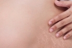 Is there a cure for stretch marks?