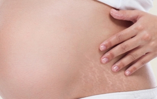 Is there a cure for stretch marks?