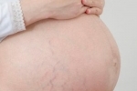 Preventing stretch marks