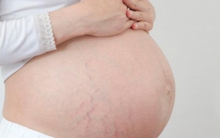 Preventing stretch marks