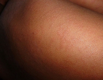 rubella rash