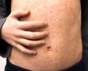 Measles outbreak
