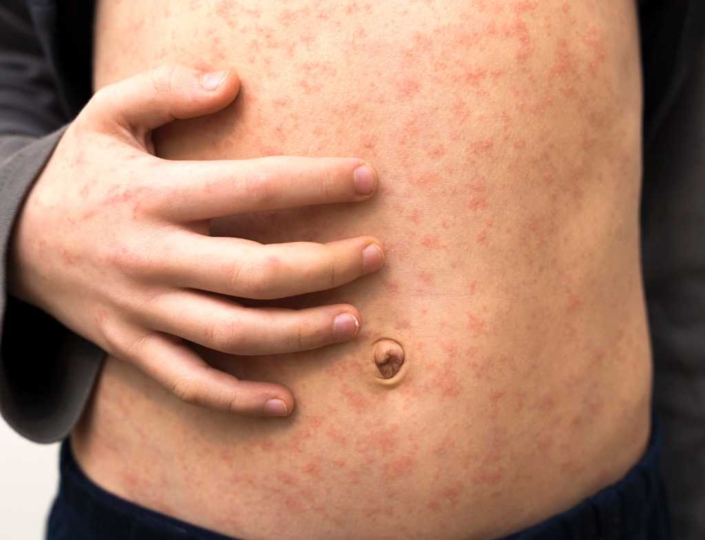 What parents need to know about the global measles outbreak